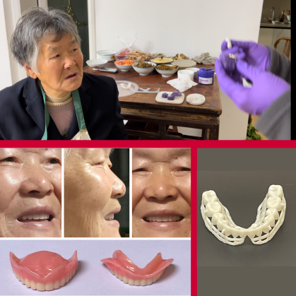 Dentures that Hua Zhu made for her aunt in her kitchen in China.